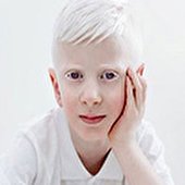 آلبینیسم یا زالی؛ علائم، علل، عوارض و انواع آن