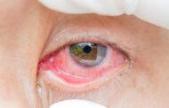 قرمز شدن چشم‌ها؛ از علت تا درمان