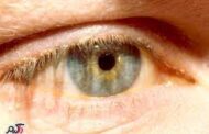 هاله زرد رنگ اطراف چشم، نشانه کلسترول بالا