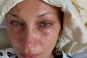 بیماری جدید بلا حدید همه را غافلگیر کرد
